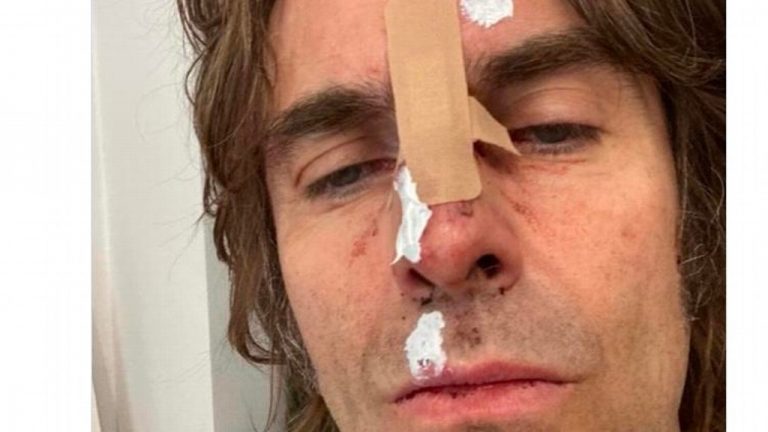 Liam Gallagher aparece con golpes en el rostro tras sufrir accidente