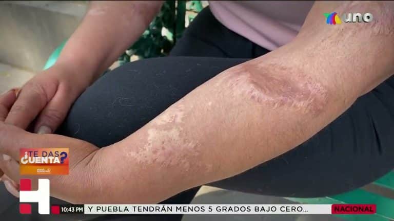 Carmen fue víctima de violencia; su expareja le arrojó ácido y le causó severos daños